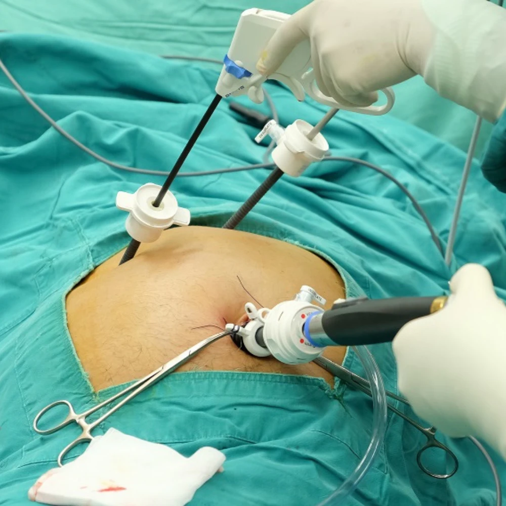 Gall Bladder Surgery