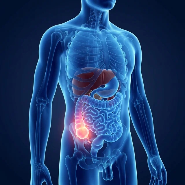 appendix-surgery