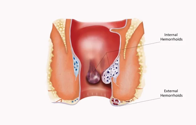laser-piles surgery